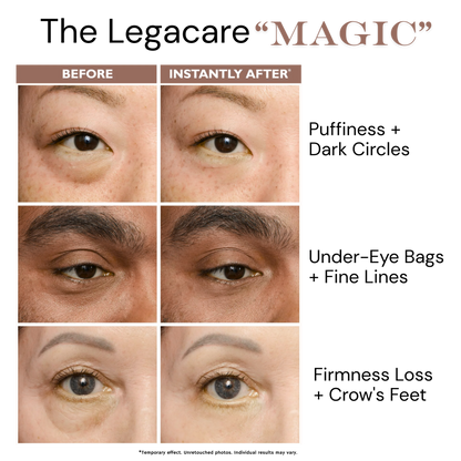 Temporary Eye Tightener